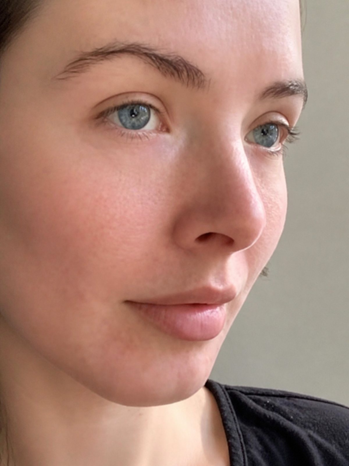 Skin after 4 weeks of sleeping on an Aveloor silk pillowcase